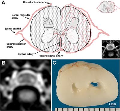 Canine Snake-Eye Myelopathy: Clinical, Magnetic Resonance Imaging, and Pathologic Findings in Four Cases